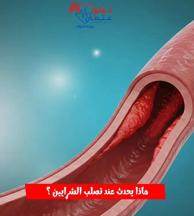 دليلك الشامل لتصلب الشرايين لعام 2026